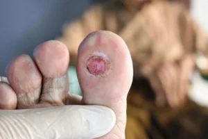 Warning Signs of Diabetic Foot You Should Never Ignore
